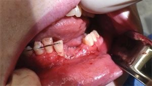 E-cigarette explodes-2