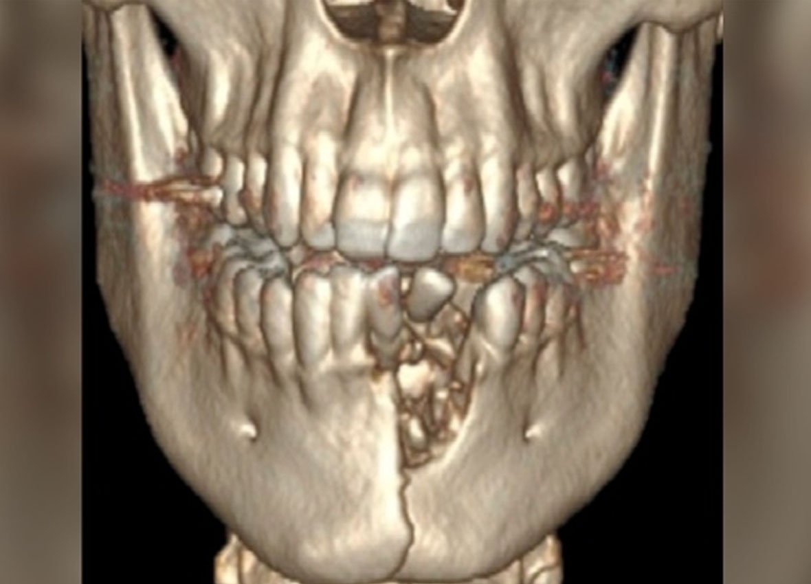 E-cigarette explodes