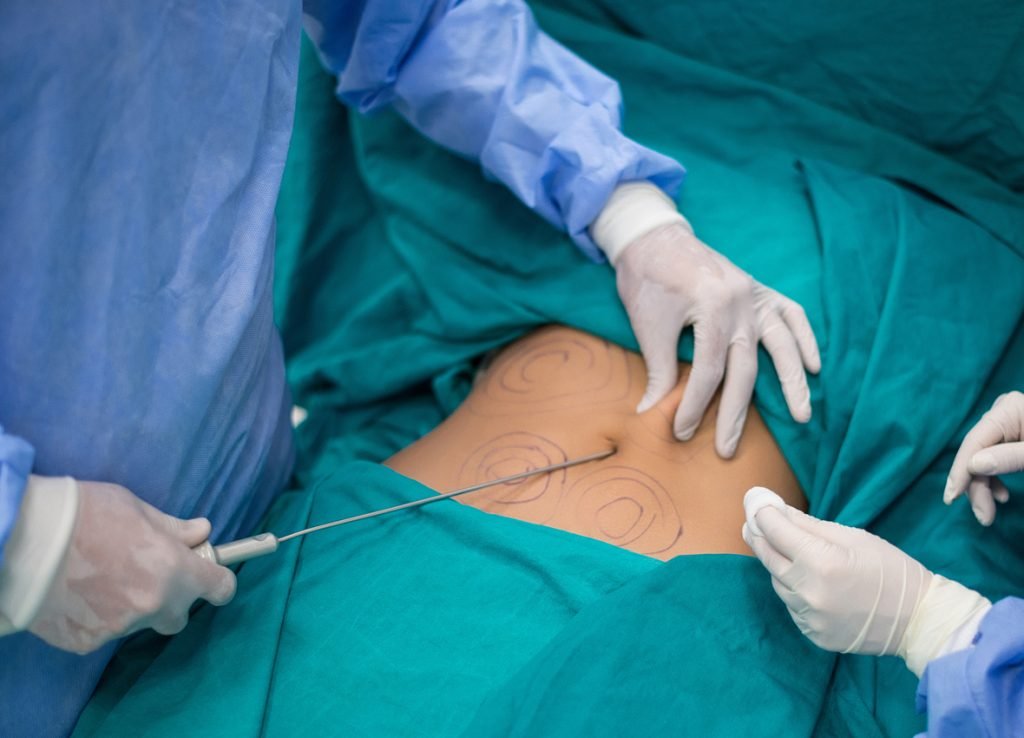 liposuction