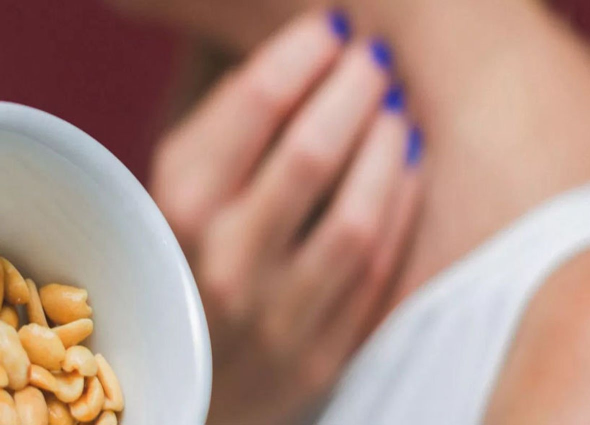 FOOD ALLERGY